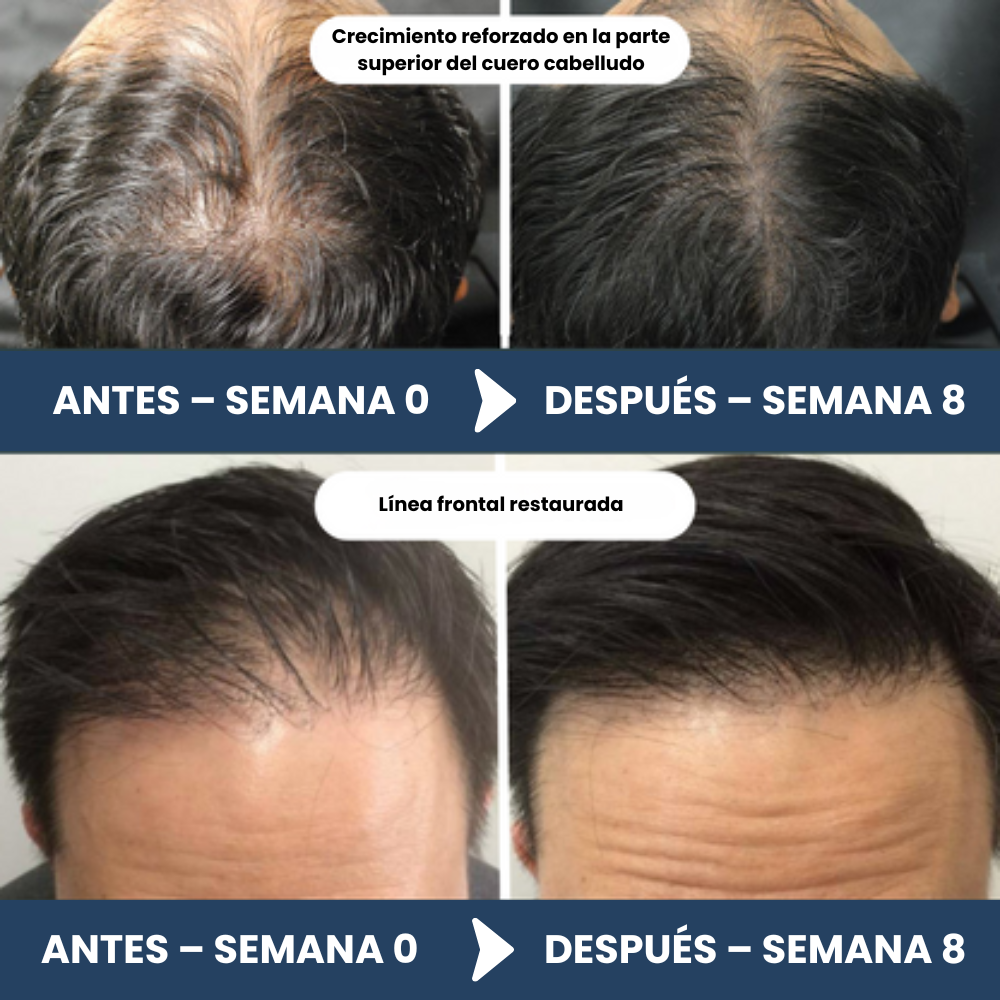 Sistema anticaída capilar para hombre Melovya®
