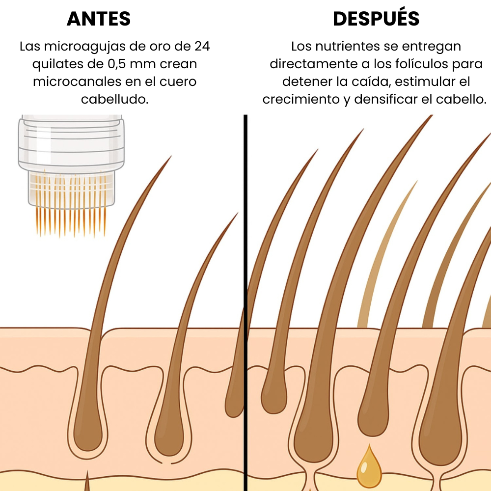 Sistema anticaída capilar para hombre Melovya®